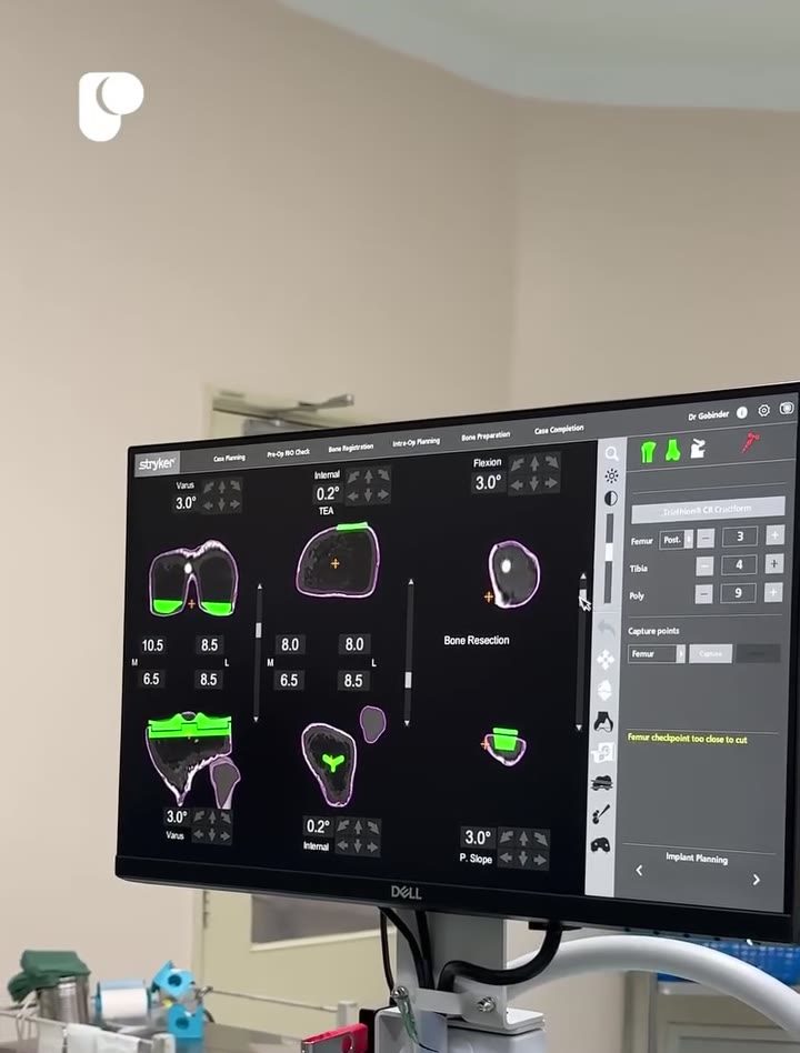 The robotic system’s planning screen showing a three-dimensional model of a knee with implant position and alignment figures